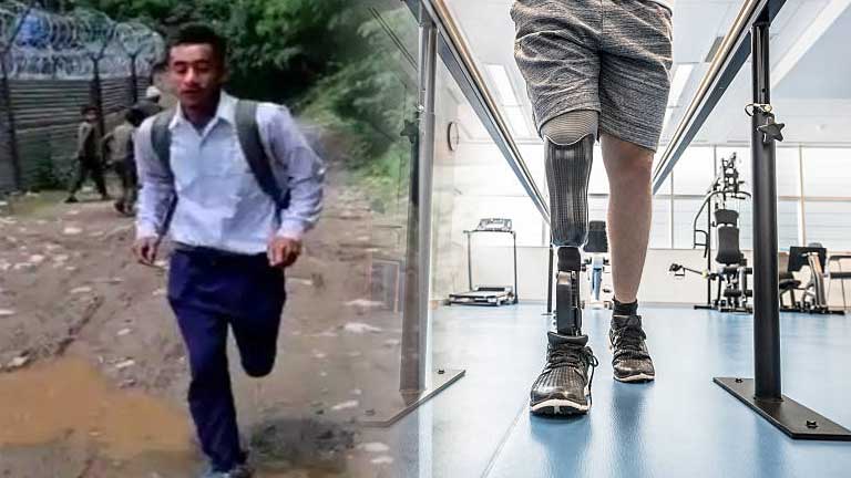 Parvez-will-soon-get-prosthetic-leg